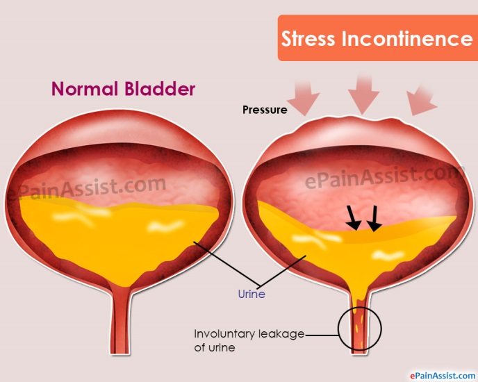 What Is Stress Incontinence